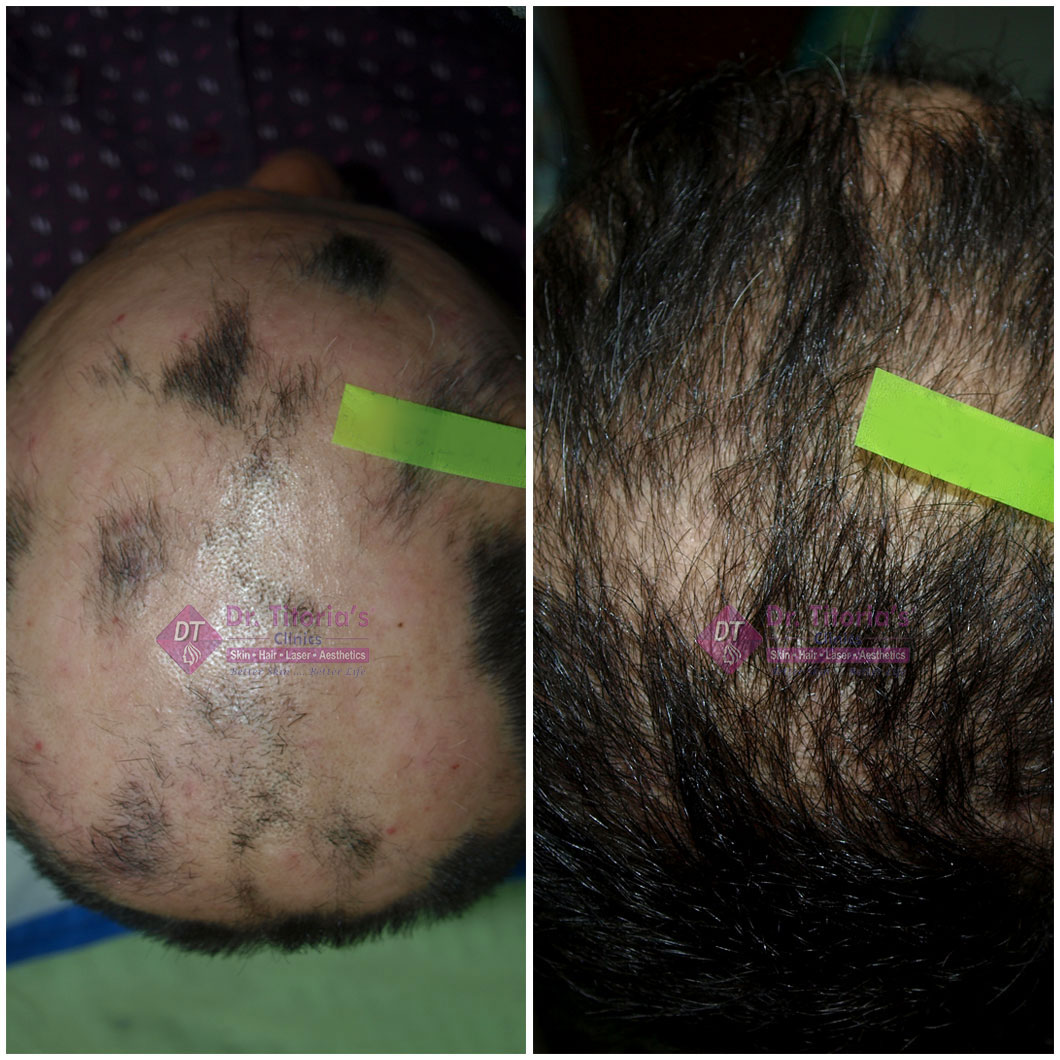 Mesotherapy Results