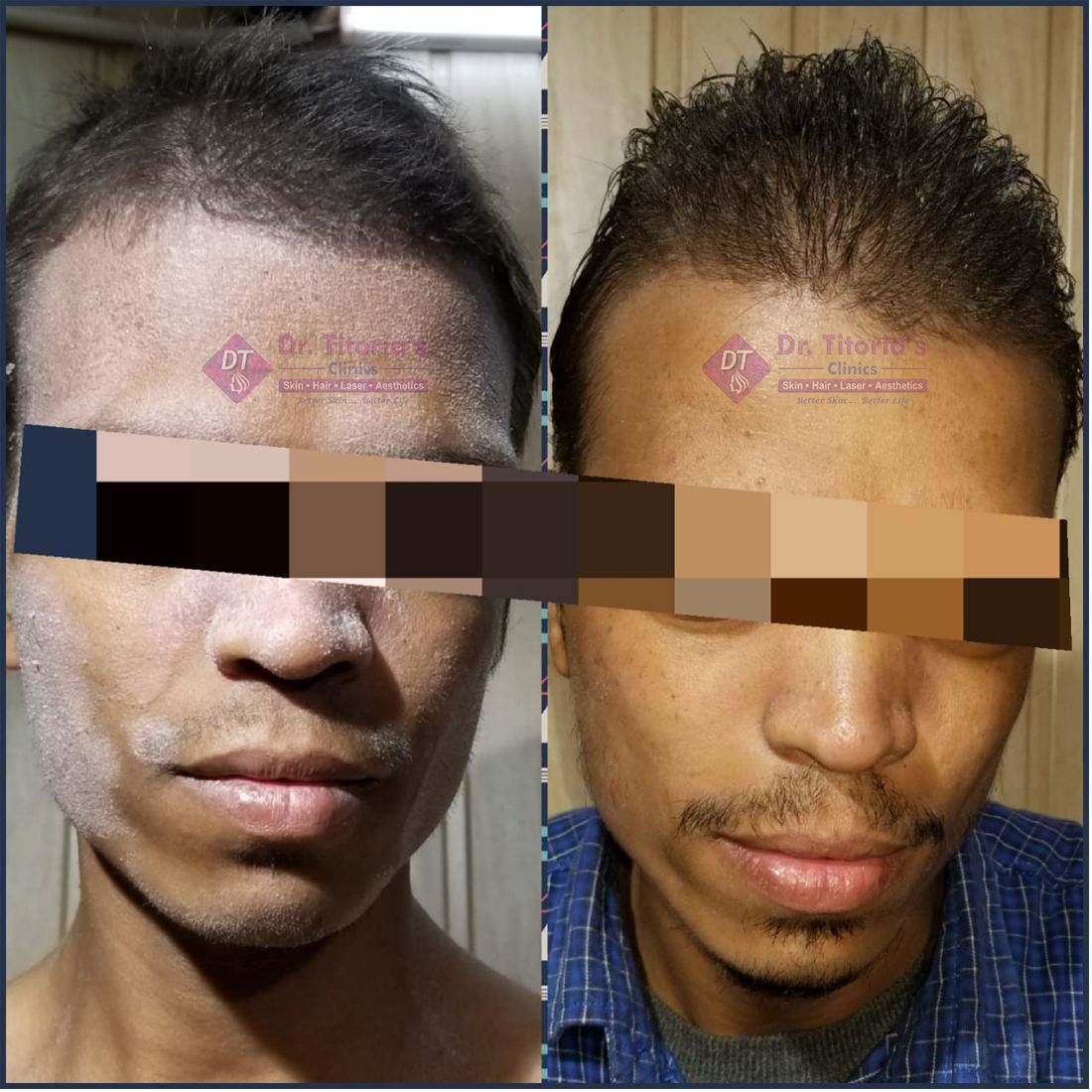 Psoriasis on Face